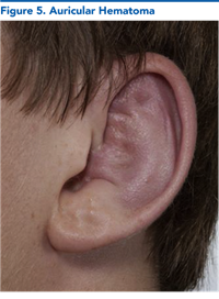Figure 5. Auricular Hematoma