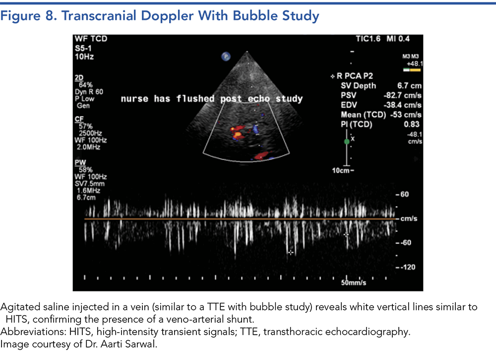 Figure 8. Transcranial Doppler With Bubble Study