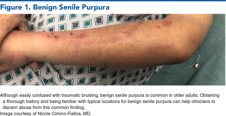 Figure 1. Benign Senile Purpura