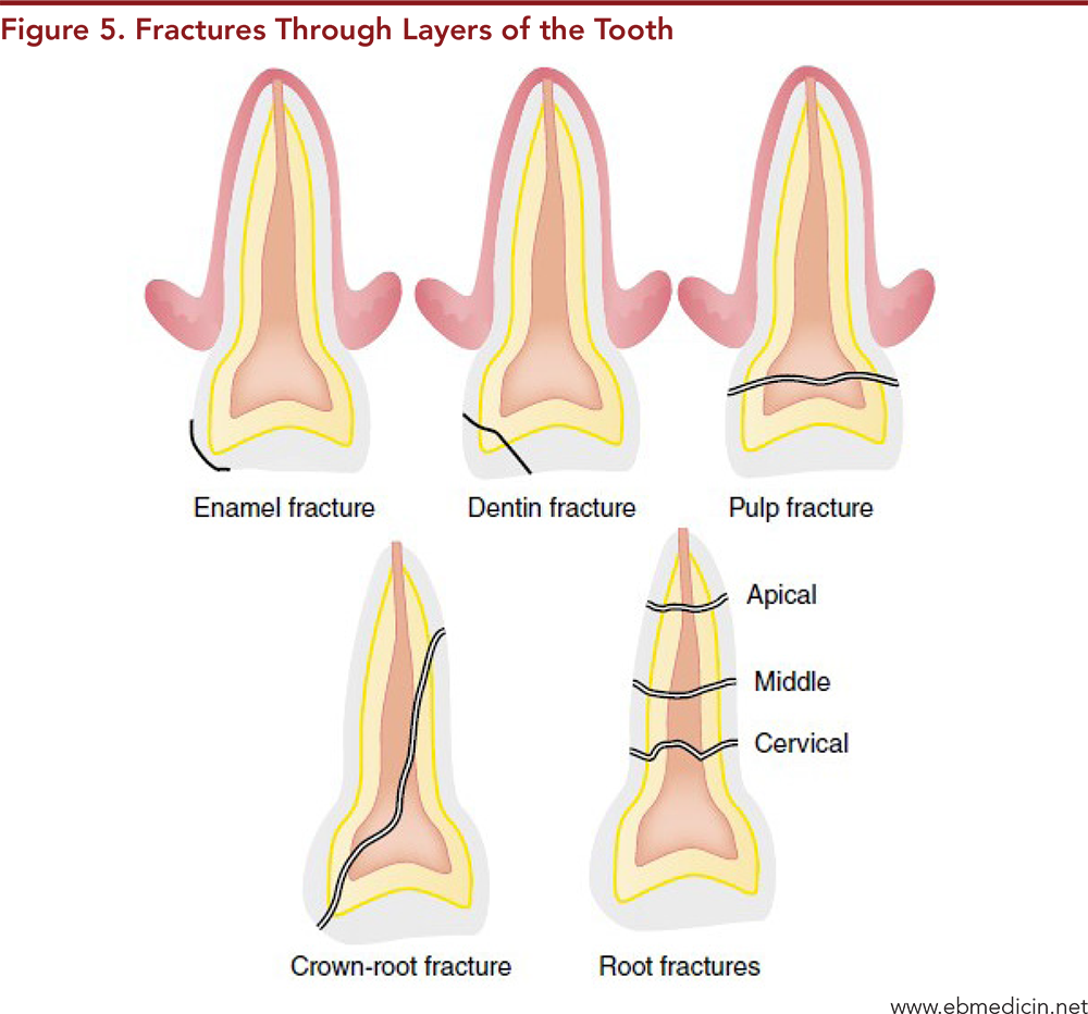 Figure 5. Fractures Through Layers of the Tooth