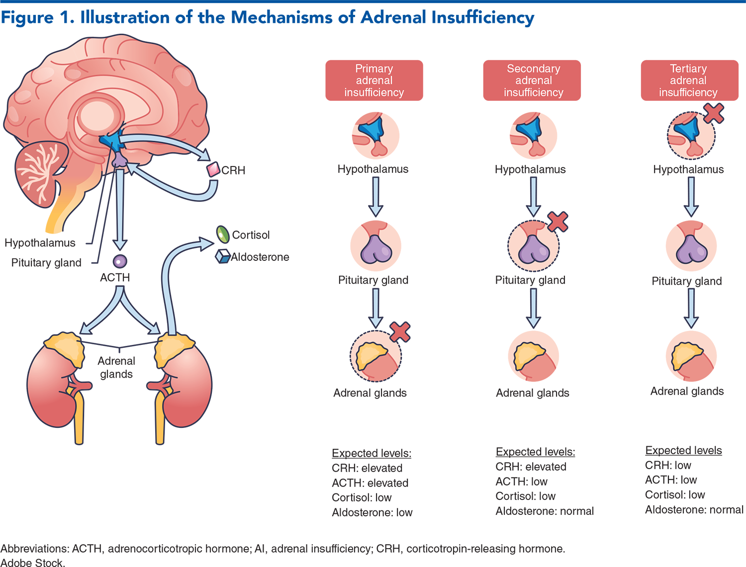 Figure 1. Illustration of the Mechanisms of Adrenal Insufficiency
