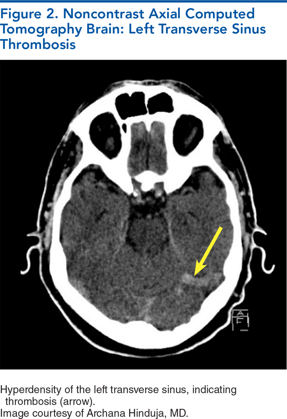 Figure 2. Noncontrast Axial Computed Tomography Brain: Left Transverse Sinus Thrombosis