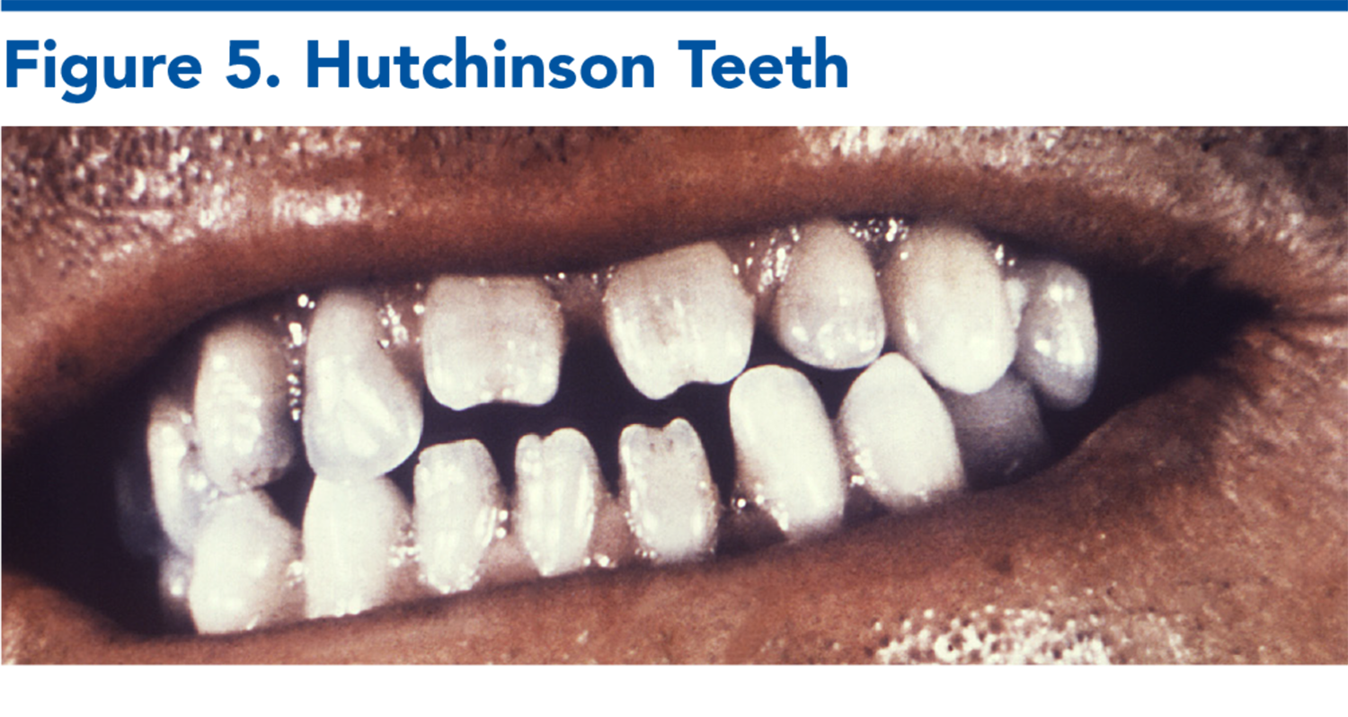 Figure 5. Hutchinson Teeth 