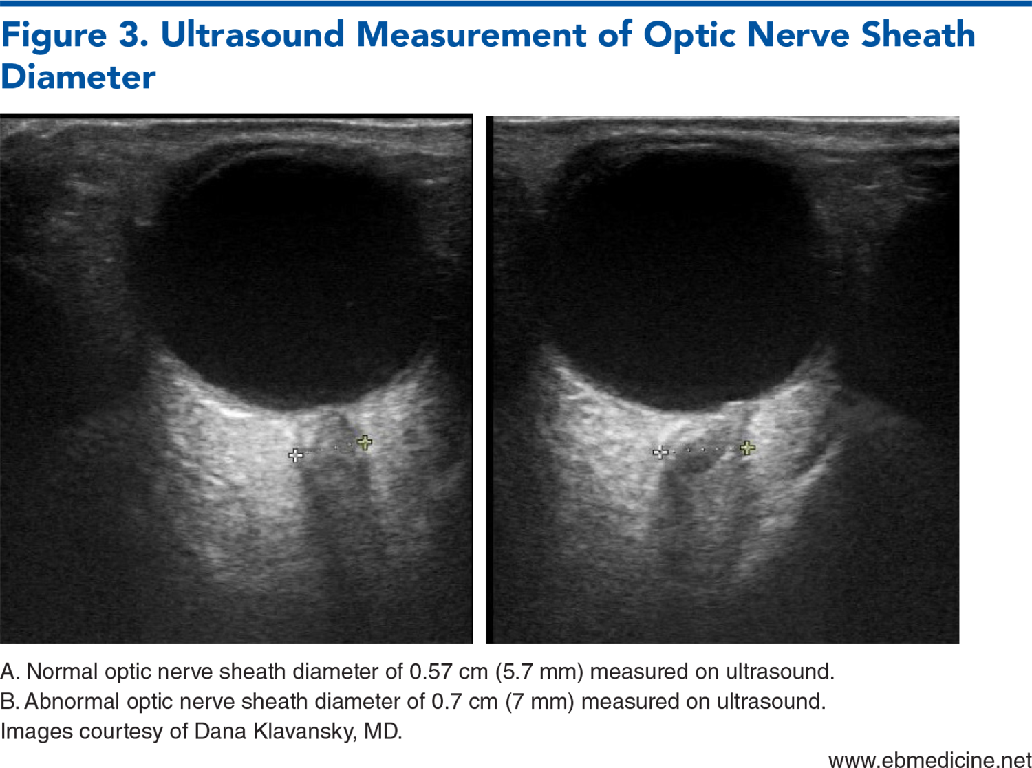 Figure 3. Ultrasound Measurement of Optic Nerve Sheath Diameter