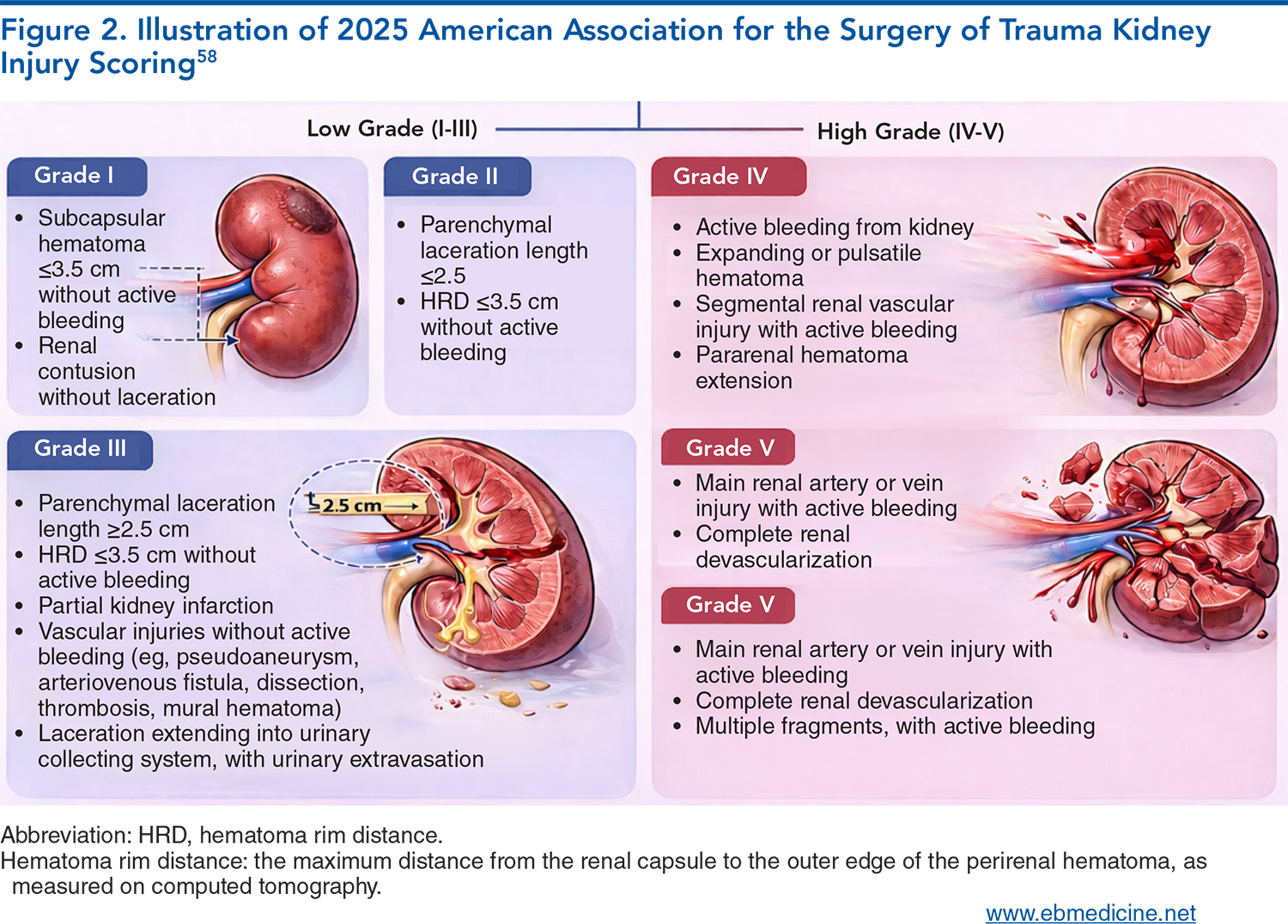 Figure 2. Illustration of 2025 American Association for the Surgery of Trauma Kidney Injury Scoring
