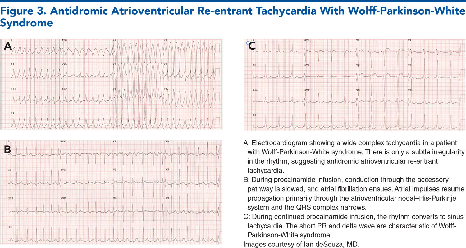 Figure 3. Antidromic Atrioventricular Re-entrant Tachycardia With Wolff-Parkinson-White Syndrome