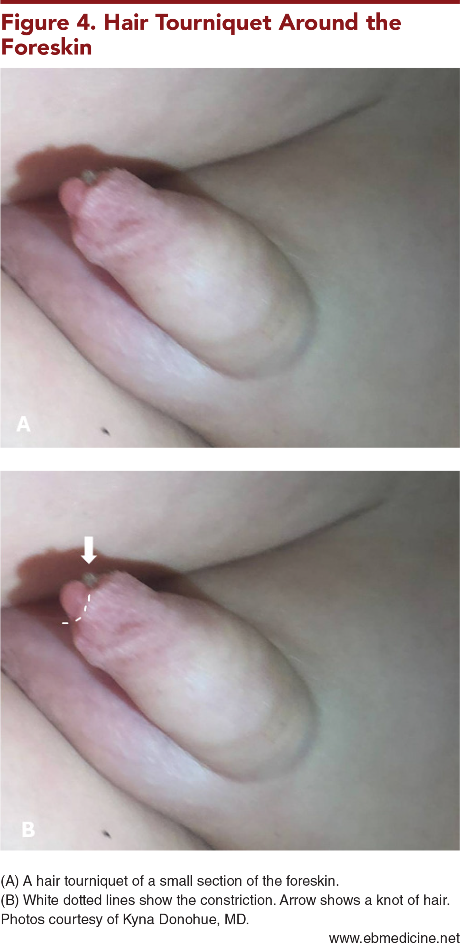 Figure 4. Hair Tourniquet Around the Foreskin