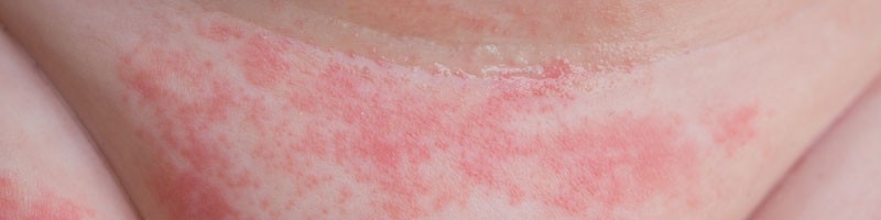 Neonatal Rashes Banner