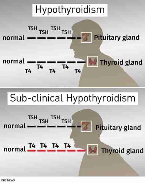 Calculate Bmr With Hypothyroidism