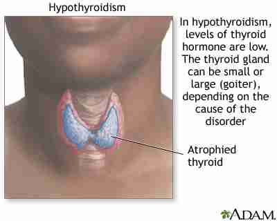 My Hypothyroidism Is Gone