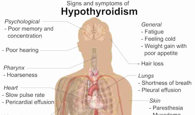 Hypothyroidism Sleeping A Lot