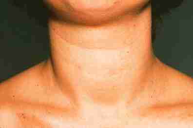 Can Hypothyroidism Cause Lbbb