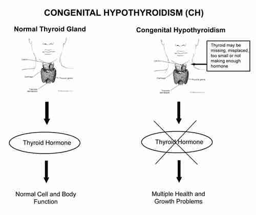 Severe Hypothyroidism In Adults Is Known As