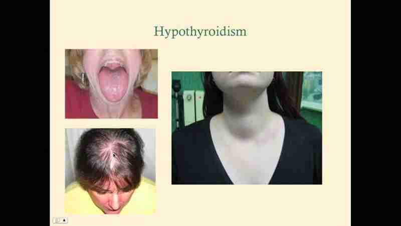 Hypothyroidism Numbers