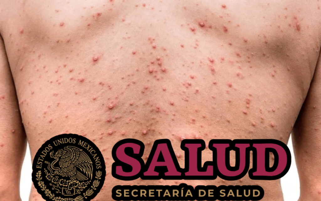 Qué Es Virus Mpox Y Cómo Se Contagia La Enfermedad Que Ya Cobró Qué Es Virus Mpox Y Cómo Se Contagia La Enfermedad Que Ya Cobró
