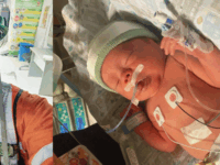 El bebé, nacido prematuro, permanece en la UCI neonatal recibiendo apoyo respiratorio mientras sus pulmones terminan de madurar.