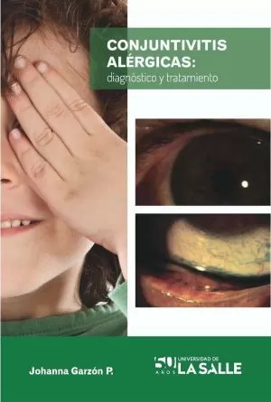 Carátula de Conjuntivitis alérgicas
