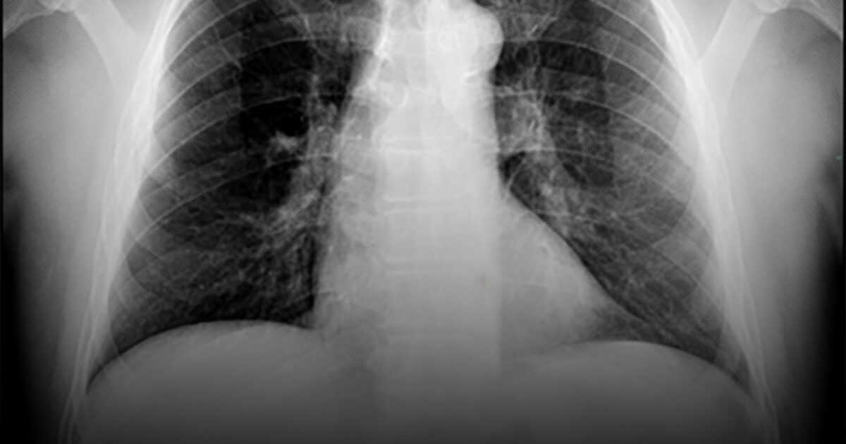 After Decades of Quiet Rumbling, an Epidemic Is Erupting Among California Stoneworkers