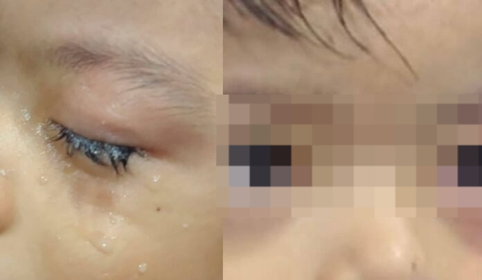 Criança tem olhos colados por cola industrial após acidente doméstico em Parintins