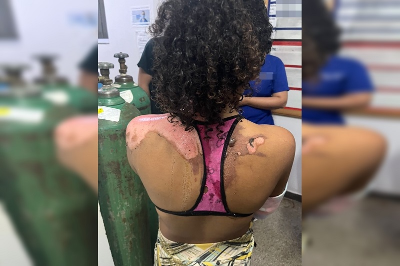 Vídeo: Tia joga água quente na sobrinha de 14 anos por ciúmes do marido