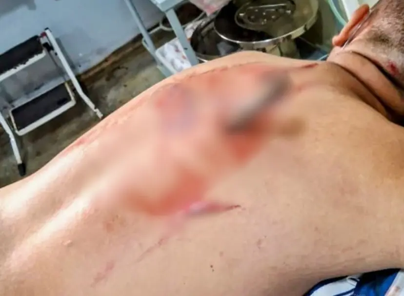 Ex-marido esfaqueia rival pelas costas em briga por ciúmes em Eirunepé