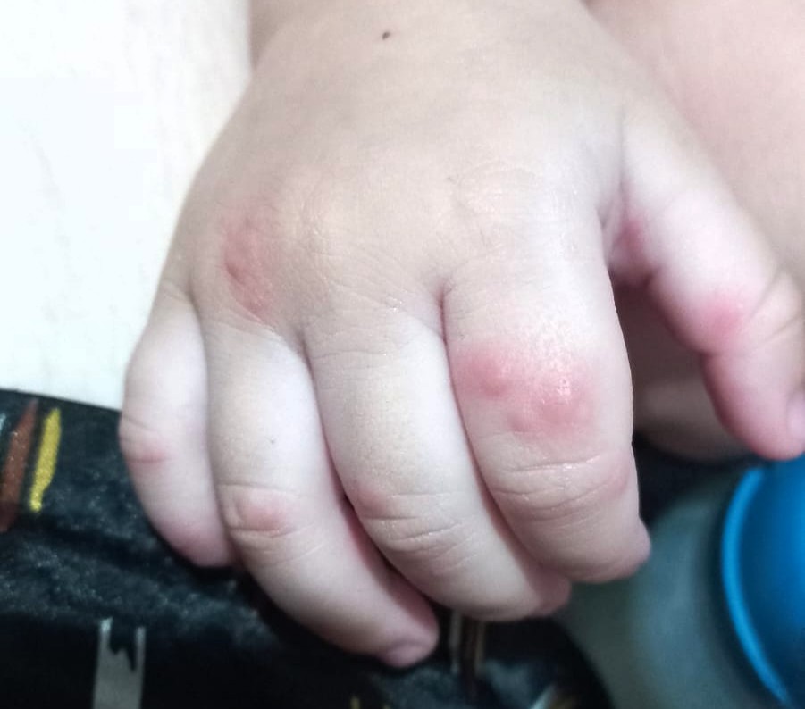 FVS-RCP reforça cuidados contra a doença mão-pé-boca