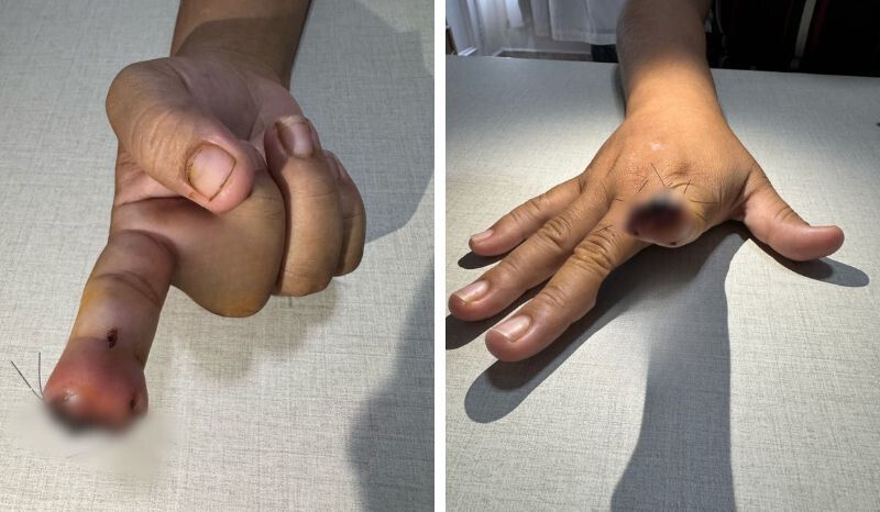 Homem arranca dedo da namorada com mordida em ataque por ciúmes em Manaus