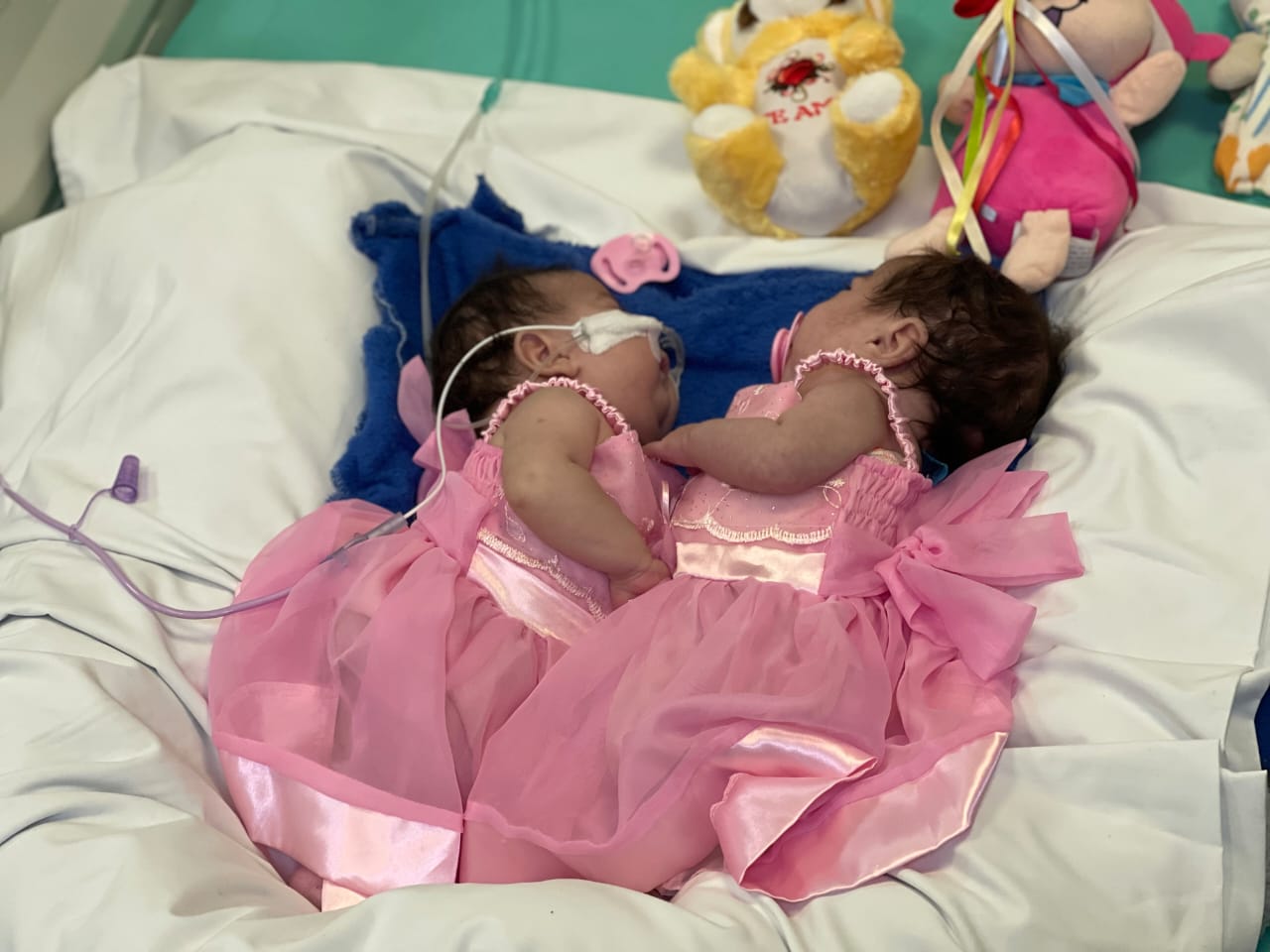 Gêmeas siamesas do Amazonas recebem alta da UTI após cirurgia complexa de separação