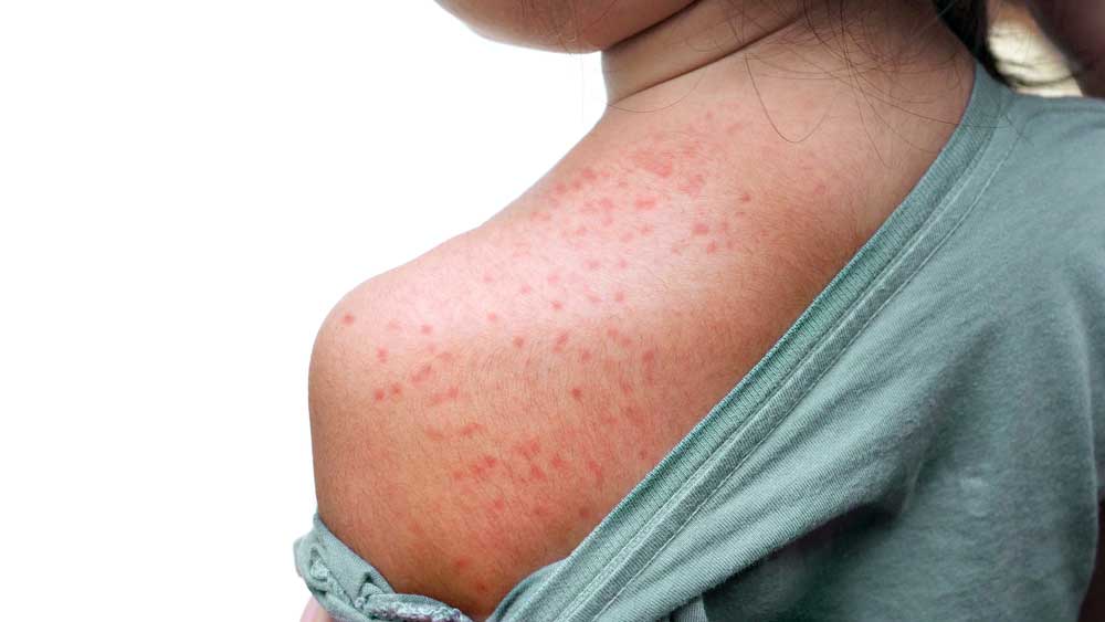 AM registrou 379 casos suspeitos de sarampo nos últimos quatro anos