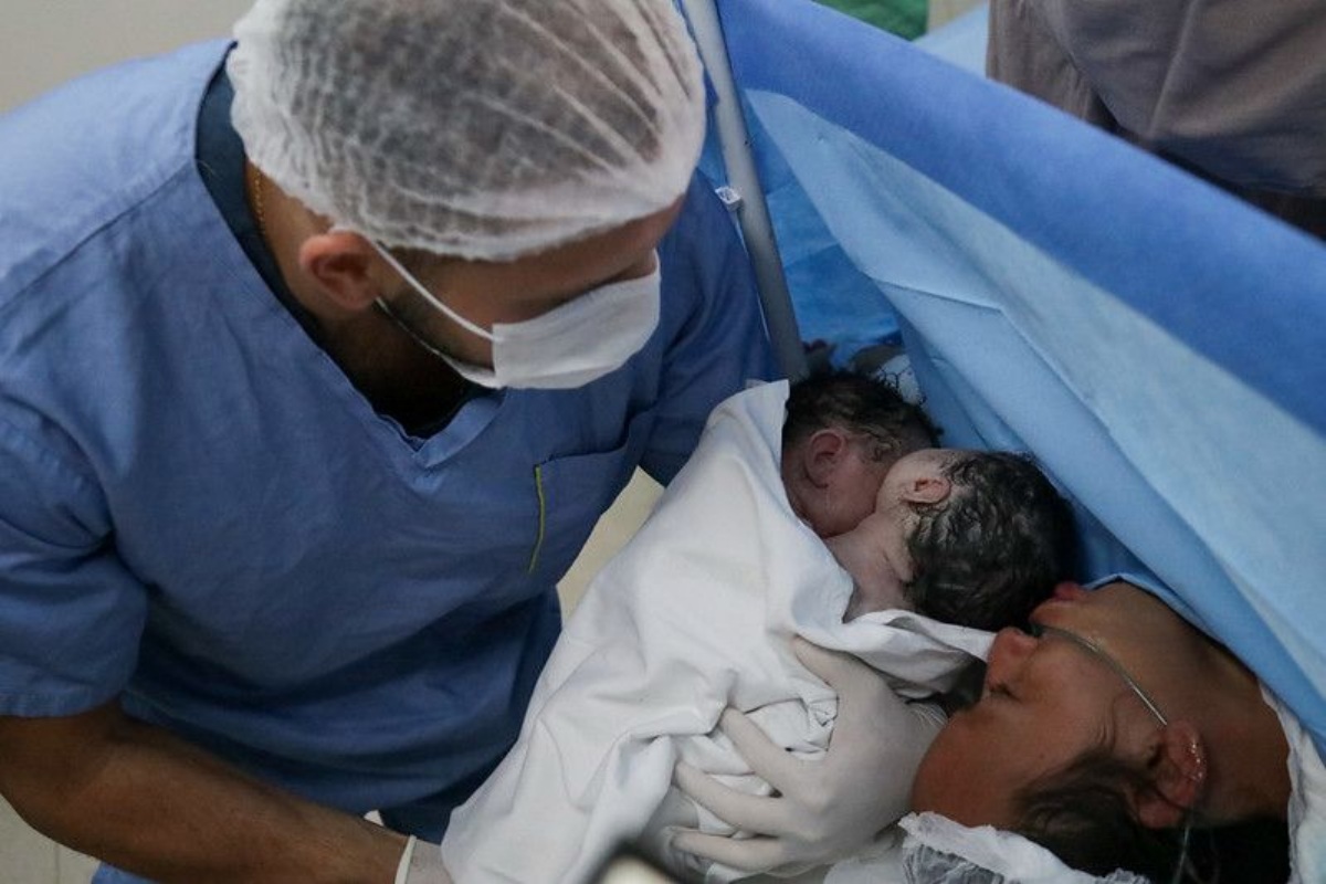 Siamesas: Meninas nascem unidas pelo abdômen em Manaus