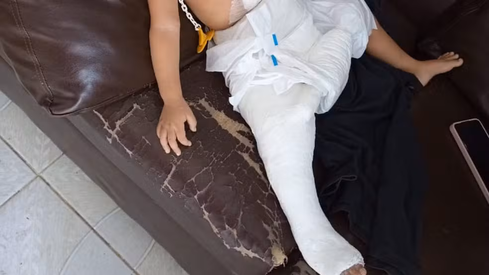 Criança tem fratura na perna após suspeita de maus-tratos em Manaus