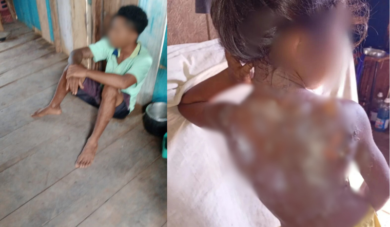 Imagem forte: Padrasto é preso após jogar mingau quente na enteada em Autazes