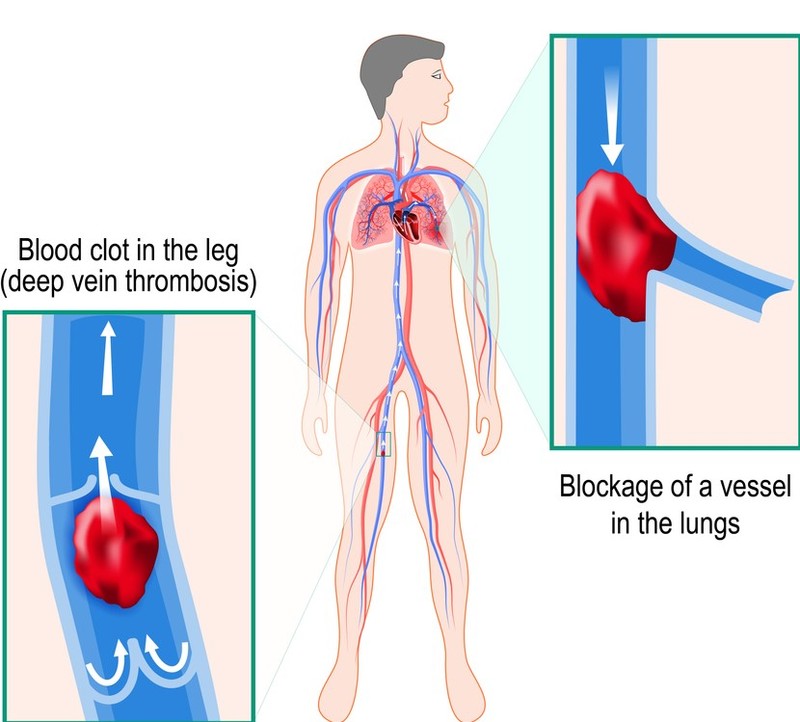 The Quick and Dirty Guide to Cor Pulmonale