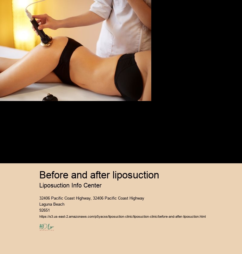 before and after liposuction Liposuction Info Center Coolsculpting