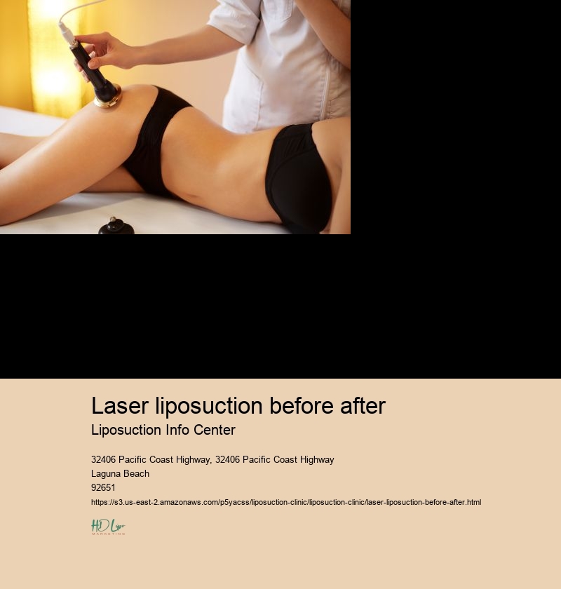 laser liposuction before after