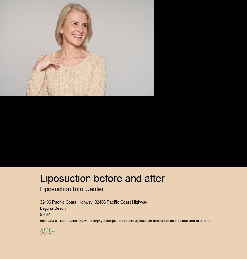 liposuction before and after Liposuction Info Center liposuction cost