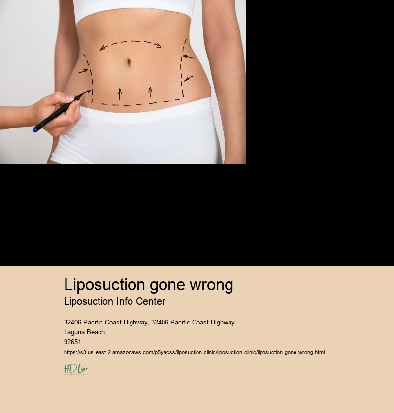 liposuction gone wrong Liposuction Info Center liposuction before and after