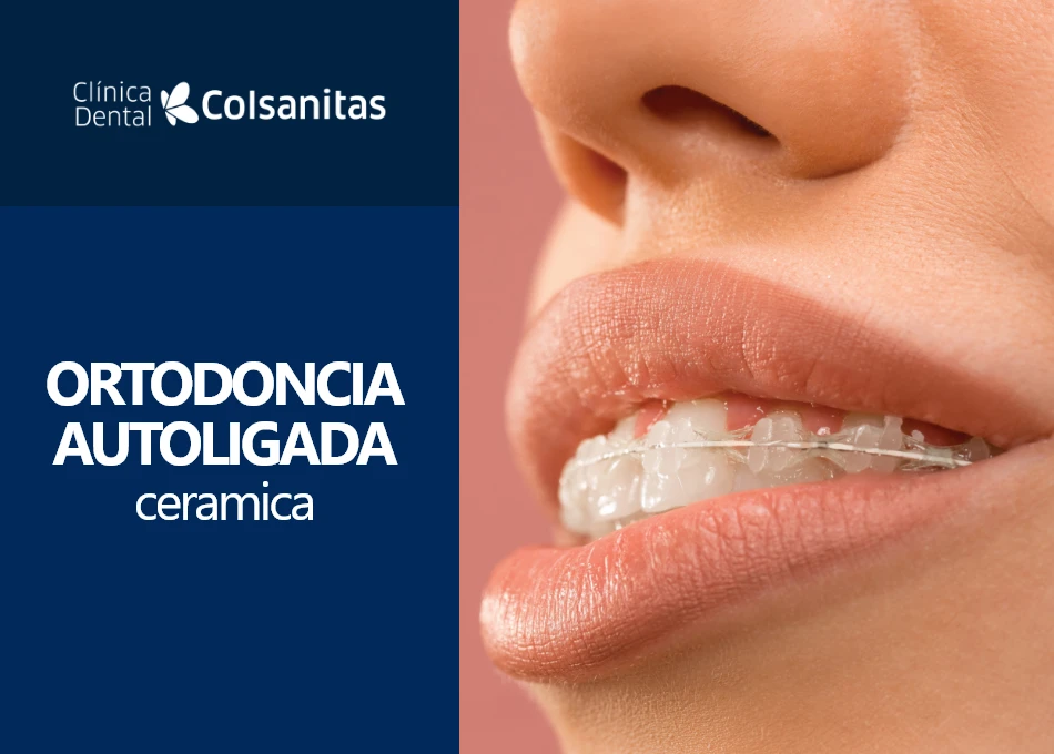 Clinicas dentales - Ortodoncia autoligada ceramica $ 6.715.700