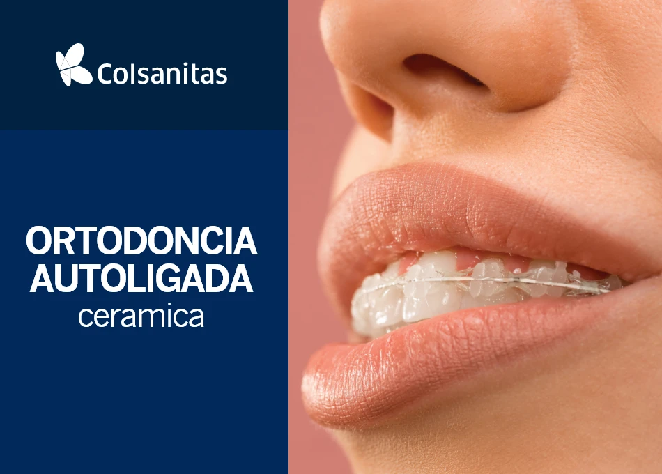 Clinicas dentales -- Ortodoncia autoligada ceramica $ 6.715.700