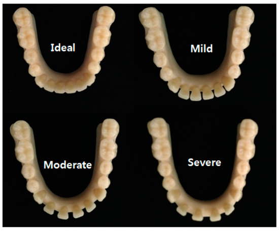 analysis-on-the-accuracy-of-intraoral-scanners-the-effects-of-mandibular-anterior-interdental-space.jpg