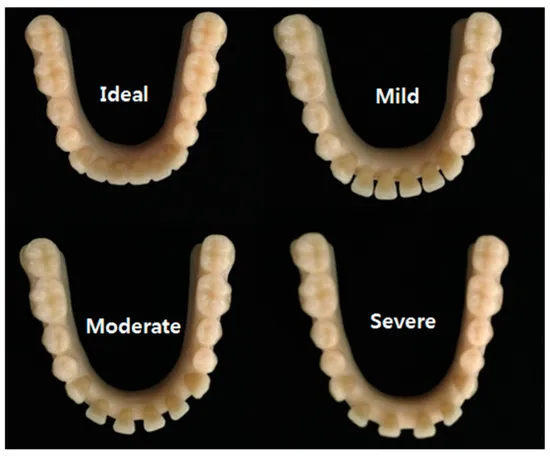 analysis-on-the-accuracy-of-intraoral-scanners-the-effects-of-mandibular-anterior-interdental-space_result.webp