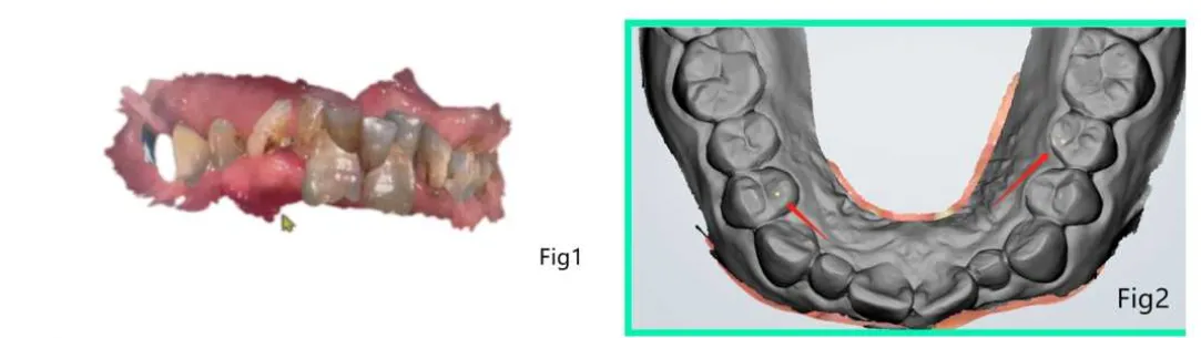 aoralscan-intraoral-scan.webp