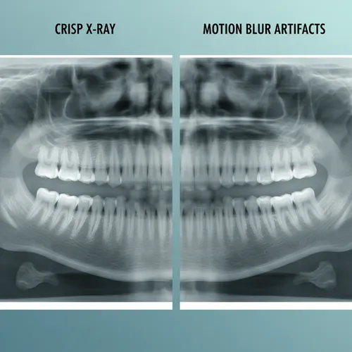crisp-vs-motion-blur-xray-artifacts.webp