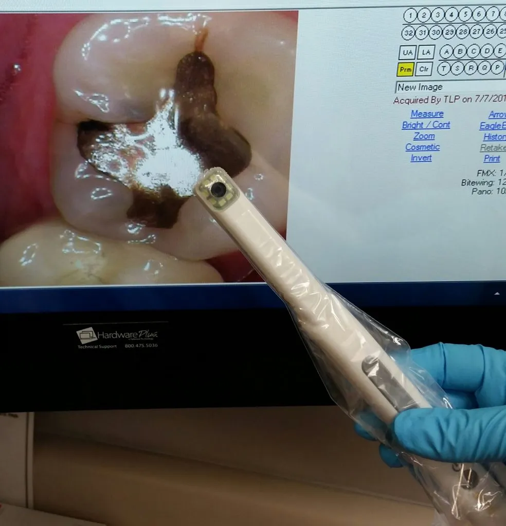 intraoral-camera-image.webp