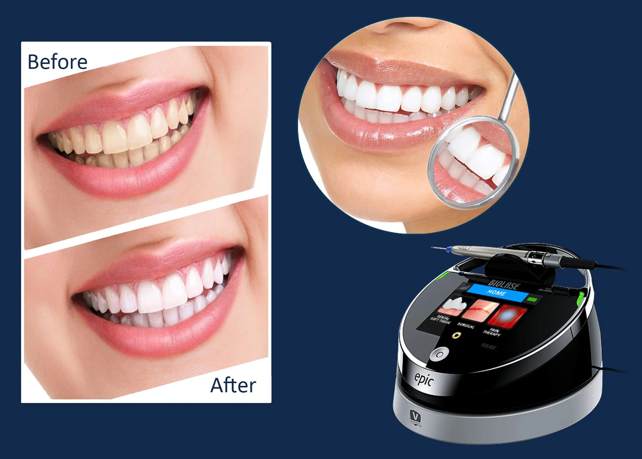 teethwhitening-biolase-laser-handpeice.webp