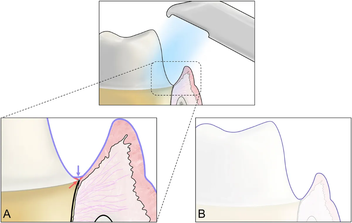 trueness-of-intraoral-scanners-according-to-subgingival-depth-of-abutment-for-fixed-prosthesis_result.webp