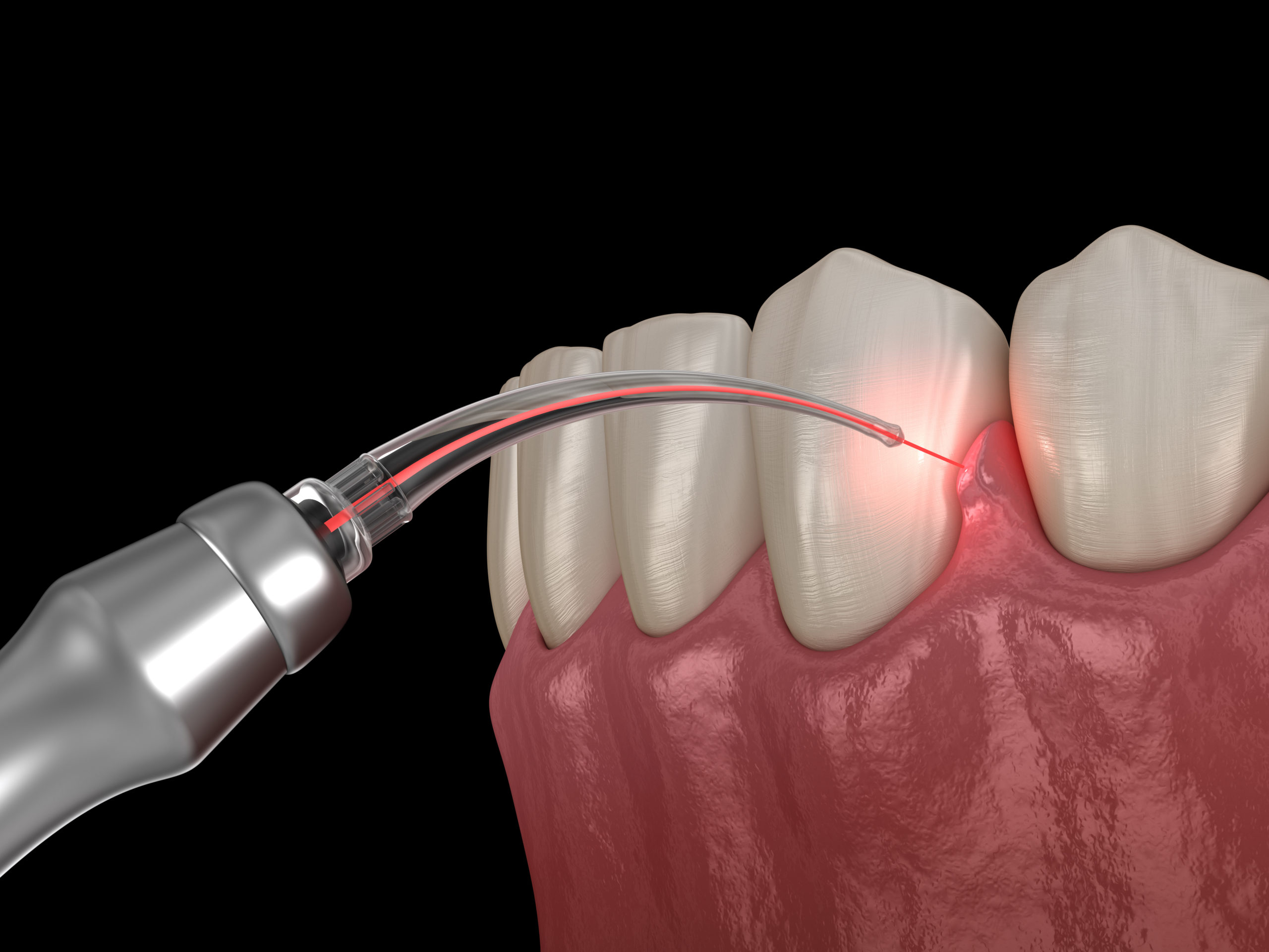 what-procedures-can-i-use-laser-dentistry-for-scaled-1.jpeg