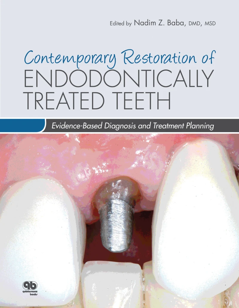 Portada: Contemporary Restoration of Endodontically Treated Teeth