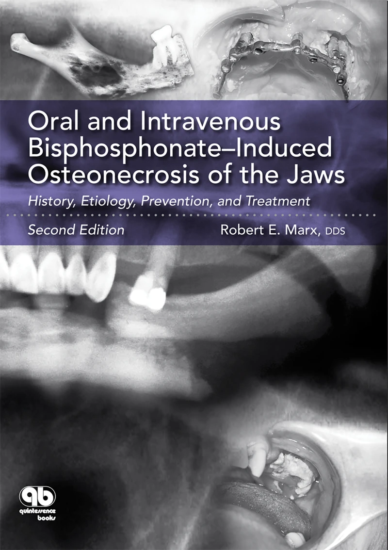 Portada: Oral and Intravenous Bisphosphonate–Induced Osteonecrosis of the Jaws