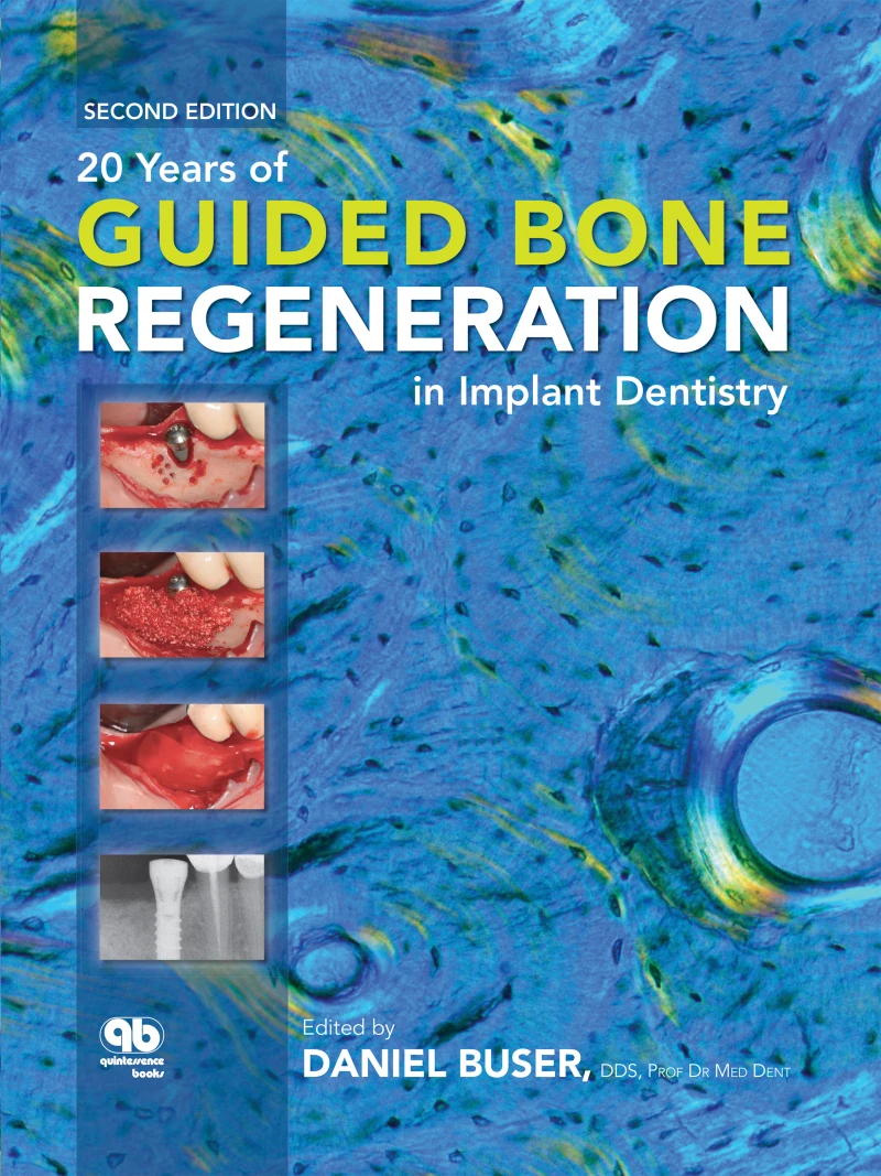 Portada: 20 Years of Guided Bone Regeneration in Implant Dentistry